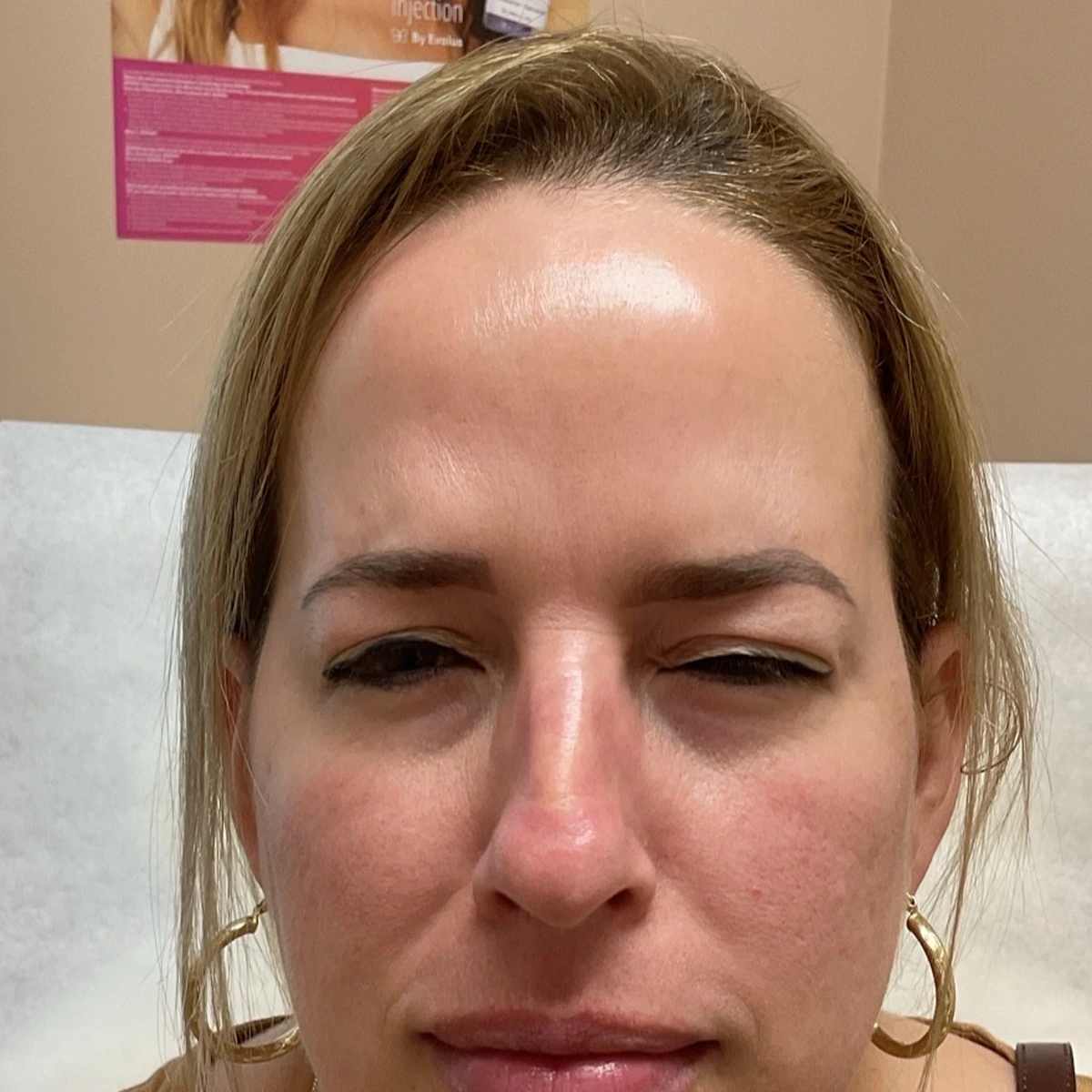 Smooth forehead result after wrinkle relaxer treatment