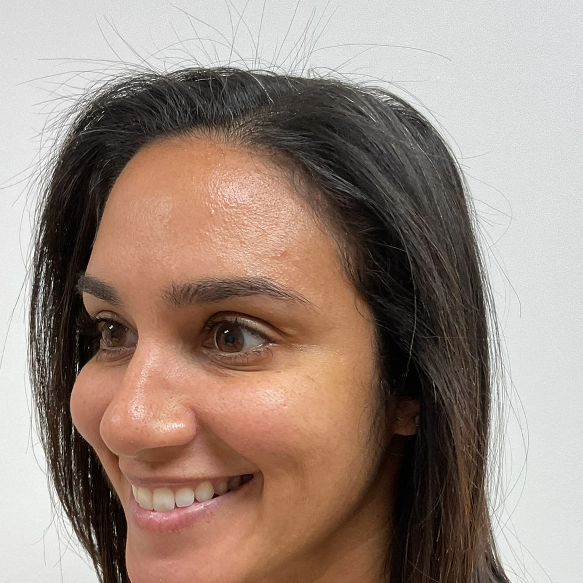 Patient smiling after wrinkle relaxer treatment